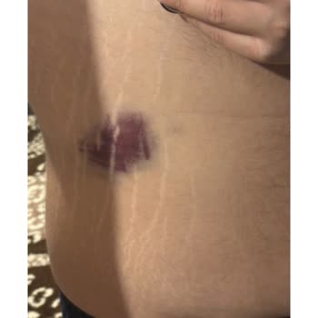 La Blanche Island Bodrum Plajda Güvenlik Eksikliği ve Lakayıt Personel Nedeniyle Yaşanan Yaralanma