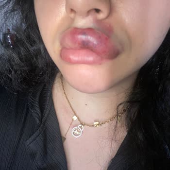 Dudak Dolgusu Sonrası Yaşanan Sağlık Ve Maddi Mağduriyet