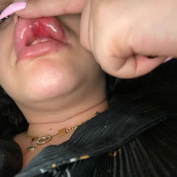 Dudak Dolgusu Sonrası Yaşanan Sağlık Ve Maddi Mağduriyet