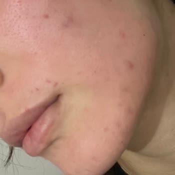 Bepantol Jel Sonrası Yüzümde Yanma Ve Şişlik Oluştu