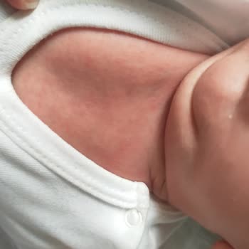 Nestle Mama Sonrası Bebekte Ciddi Alerjik Reaksiyon Ve İade Talebi