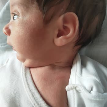 Nestle Mama Sonrası Bebekte Ciddi Alerjik Reaksiyon Ve İade Talebi