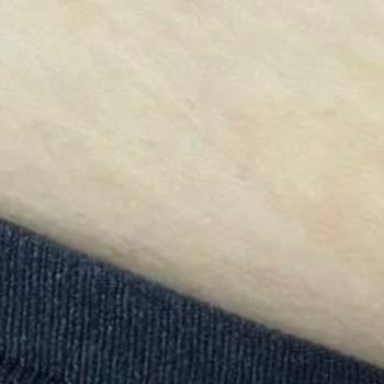 Lucita Güzellik Merkezi'nde Yanıklar, Usulsüz Ödeme Ve Müşteri Mağduriyeti