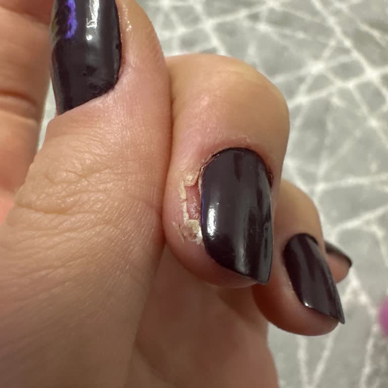 Manikür Sonrası Tırnak Mantarı Ve Hijyen Sorunu