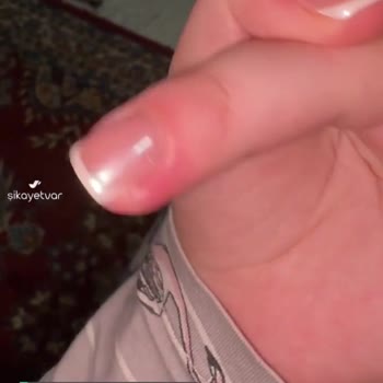 Gratis Beauty Tırnak İltihabı Sorunu