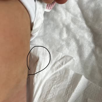 Bebek Bezinde Tehlikeli Yabancı Cisim Şoku