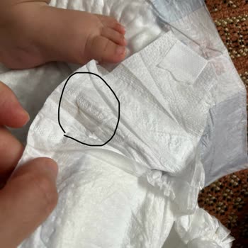 Bebek Bezinde Tehlikeli Yabancı Cisim Şoku