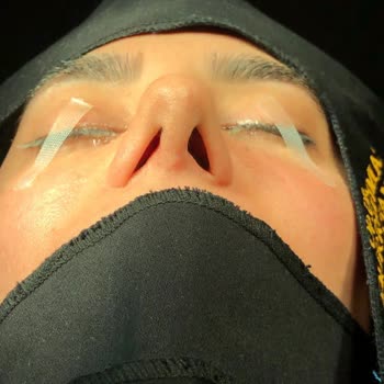 Burun Estetiği Sonrası Mağduriyetim Giderilmedi