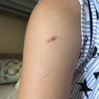 Lazer Epilasyon Sonrası Yanık Ve İlgisizlik: Param Boşa Gitti