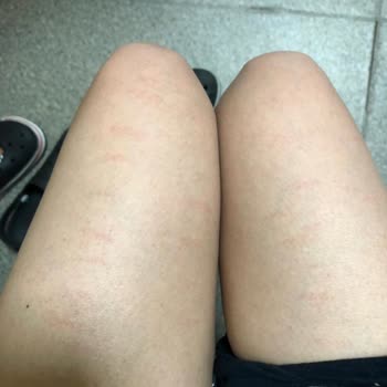 Lazer Epilasyon Sonrası Yanık Ve İlgisizlik: Param Boşa Gitti