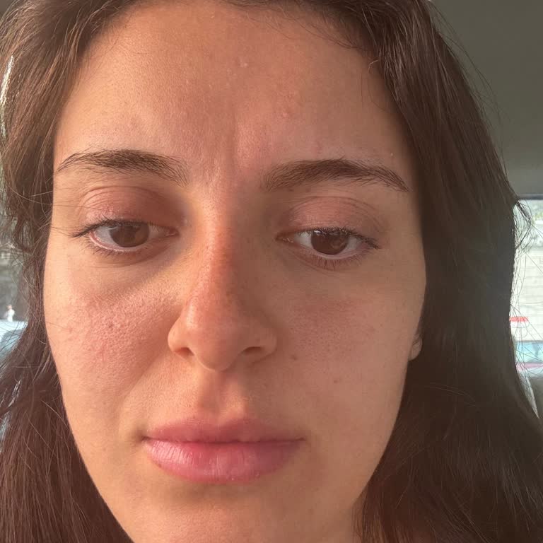 Kirpik Lifting İşlemi Sonuçsuz Kaldı, Ücret İadesi Yapılmıyor