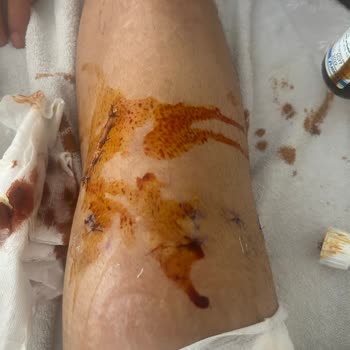 Martı Tag Şoförlü Motosiklet Kazası Sonrası İlgisizlik Ve Sorumluluk Eksikliği