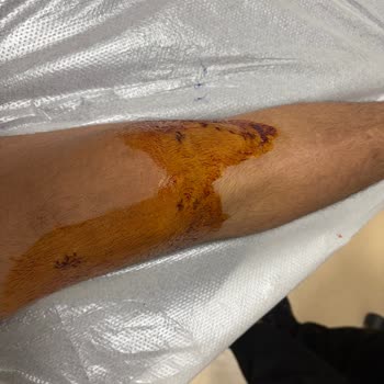 Martı Tag Şoförlü Motosiklet Kazası Sonrası İlgisizlik Ve Sorumluluk Eksikliği