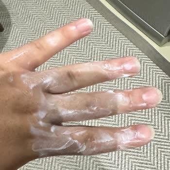 İlk Kullanımda Patlayan Sıcak Su Torbası Nedeniyle Yaşanan Yanık Ve Mağduriyet