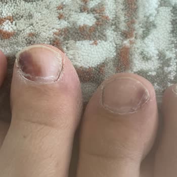 Skechers Aldığım Ayakkabı Ayağımı Yaraladı, Firma İlgisiz Kaldı