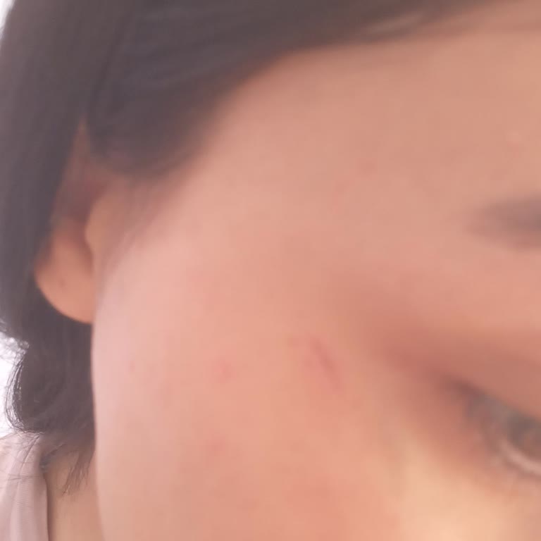 Kuaförde Yüzümde Ağda Yanığı Oluştu, Paramı İstiyorum