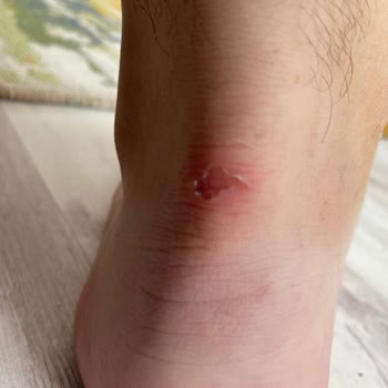 Yeni Alınan Ayakkabı Kısa Sürede Ciddi Yara Yaptı, Değişim Talebim Reddedildi