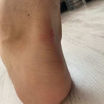 Yeni Alınan Ayakkabı Kısa Sürede Ciddi Yara Yaptı, Değişim Talebim Reddedildi