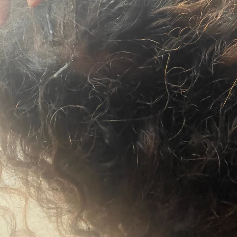 Saç Kaynak İşlemi Sonrası Saç Dökülmesi Ve İlgisizlik Mağduriyeti