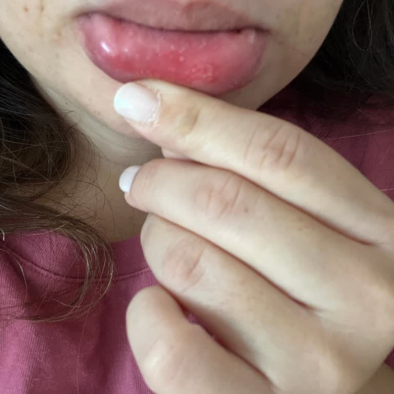 Sensodyne Complete Protection Caused Mouth Sore, Dry Mouth