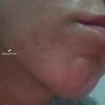 La Roche - Posay Cildim Çok Kötü Bir Hale Geldi