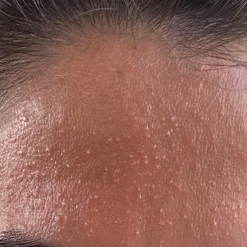 Nemlendirici Krem Kullanımı Sonrası Cilt Sorunu Ve İade Talebi