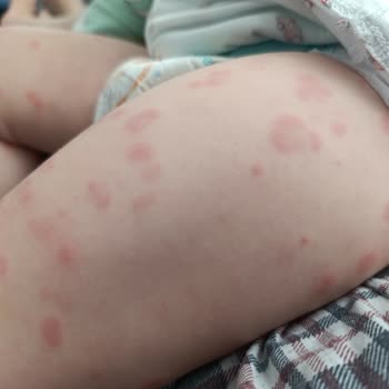 Bebelac 4 Formula Triggered Severe Allergy and Rashes in My 13-Month-Old Baby