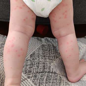 Bebelac 4 Formula Triggered Severe Allergy and Rashes in My 13-Month-Old Baby