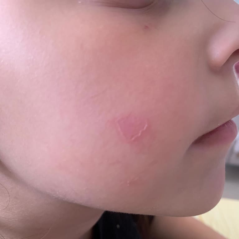 Tukaş Mayonez Ciltte Kızarıklık Ve Yanık Benzeri Etki Yaptı, Endişeliyim