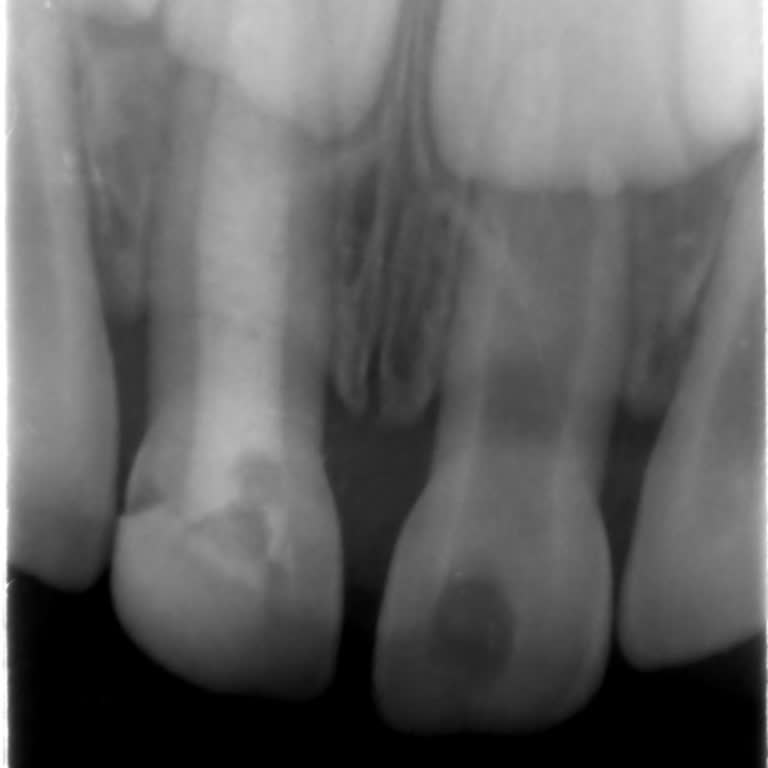 Yetkin Dent Diş Kliniği Kanal Tedavisi Yapıldığı Söylenen Diş Zamanla Çürüdü
