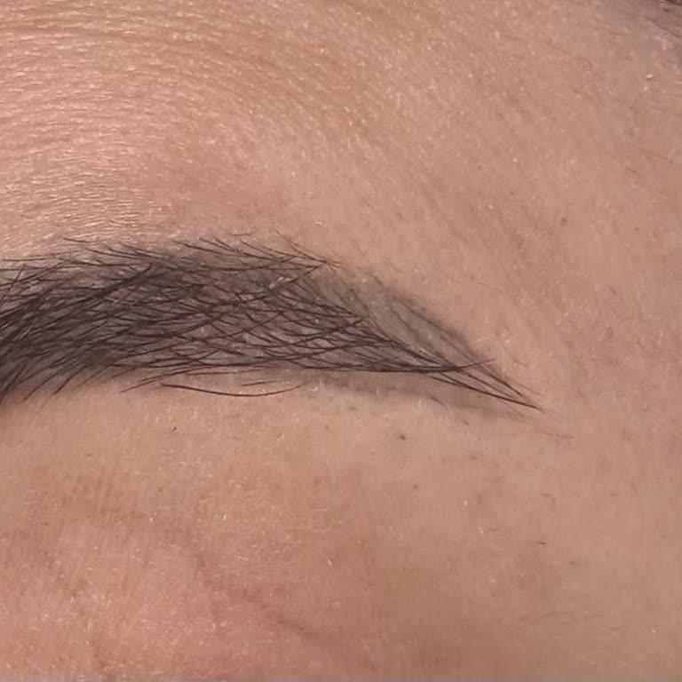 Kaş Alımı Sonrası Ciltte Yaralar Ve Eşitsiz Tasarım Nedeniyle Mağduriyet