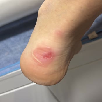 İlk Kullanımda Ayağımı Yaralayan Adidas Ayakkabı Hayal Kırıklığı