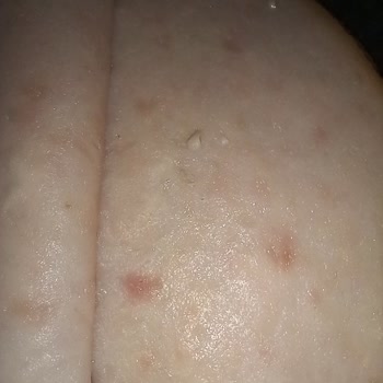 Aldığım Hindi Füme Ürününde Yabancı Cisimle Karşılaştım, Sağlık Endişesi Yaşıyorum