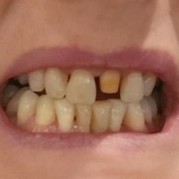 Klinik 45’te Yapılan Hatalı Diş Tedavisi Sonucu Yaşadığım Sağlık Sorunları Ve İlgisizlik