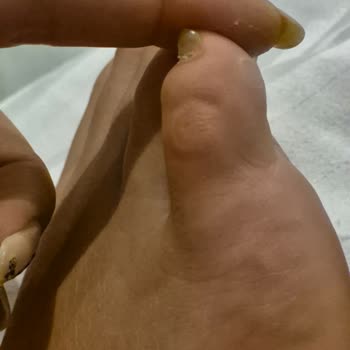 Skechers Sandalet Ayağımda Yaraya Sebep Oldu, Değişim Veya İade Talebim Reddedildi