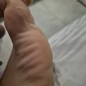 Skechers Sandalet Ayağımda Yaraya Sebep Oldu, Değişim Veya İade Talebim Reddedildi