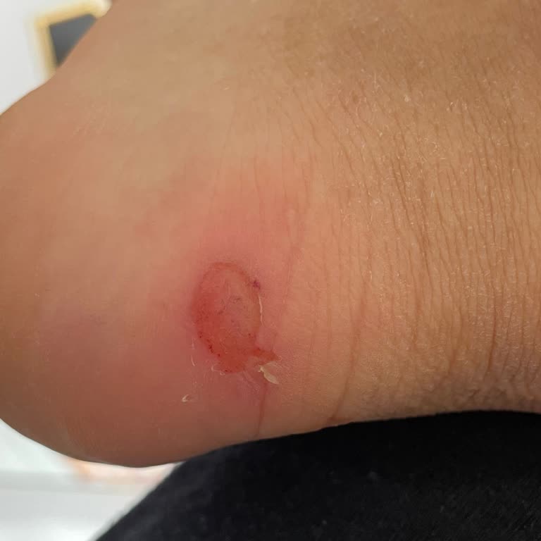 Garanti Kapsamındaki Ayakkabı Ayağımı Yaraladı, İade Talebim Reddedildi