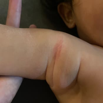 Bebek Kremi Kullanımı Sonrası Ciltte Tahriş Ve Kaşıntı Sorunu