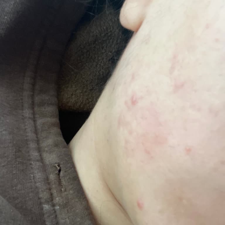 La Roche Face Wash Made My Acne Worse