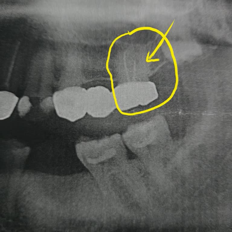 Eksik Yapılan Kanal Tedavisi Sonrası Devam Eden Ağrı Ve Mağduriyet