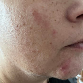 Serum Kullanımı Sonrası Cildimde Yanık Ve Akne Oluştu, Mağduriyetimin Giderilmesini İstiyorum