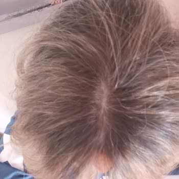 Röfle Yerine Ombre Yapıldı Saçım Kızıllık Oldu Memnuniyetsizliğim Dikkate Alınmadı