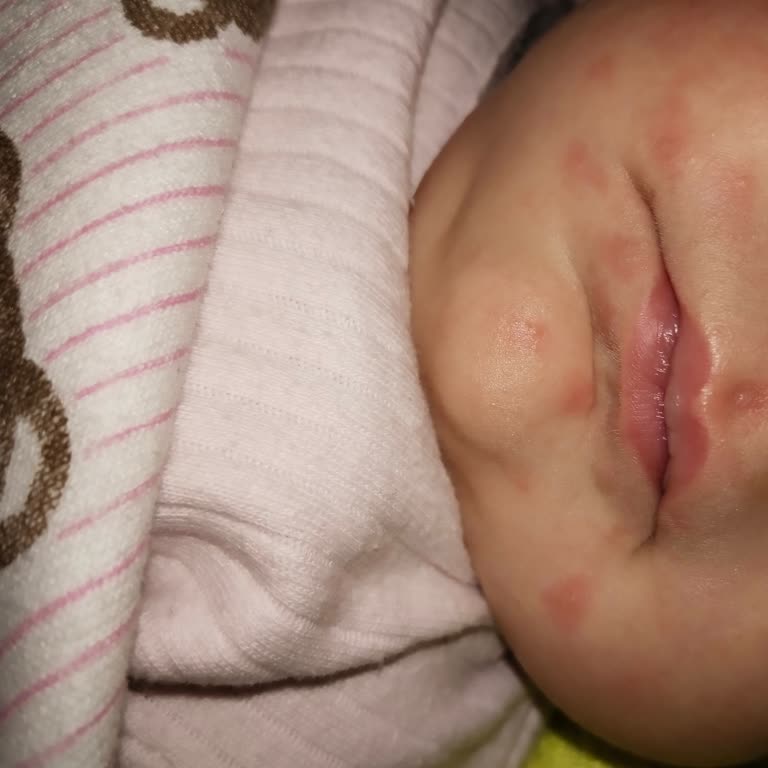 Mama Sonrası Bebeğimde Kızarıklıklar Oluştu, İade Talep Ediyorum