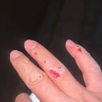 Palandöken Belediyesi Kırık Demir Izgara Tehlikesi: Acil Onarım Talebi!