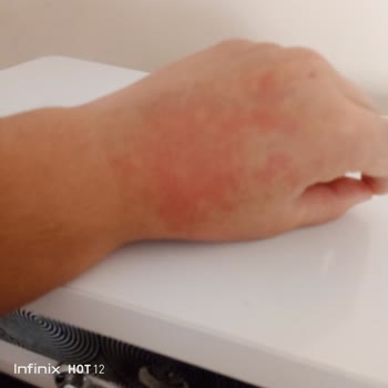 Epify Krem Ellerimde Ciddi Kızarıklık Ve Yanma Yaptı Para İadesi İstiyorum