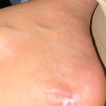 Yeni Alınan Loafer Ayakkabının Ayağı Yara Yapması Ve Yetersiz Çözüm