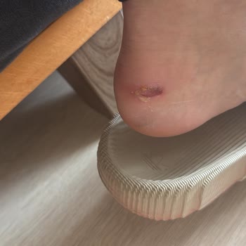 Yeni Alınan Loafer Ayakkabının Ayağı Yara Yapması Ve Yetersiz Çözüm