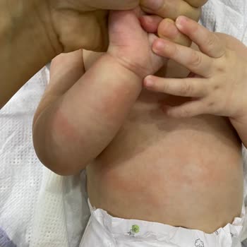 Mustela Stelatopia Sonrası Bebeğimde Kızarıklık Ve Döküntü Oluştu