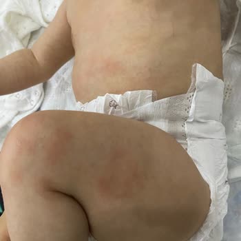 Mustela Stelatopia Sonrası Bebeğimde Kızarıklık Ve Döküntü Oluştu