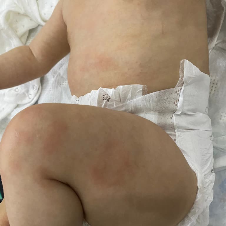 Mustela Stelatopia Sonrası Bebeğimde Kızarıklık Ve Döküntü Oluştu